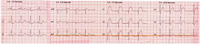 Occlusion of the Right Ventricular Wall Branch of a Recessive Right Coronary Artery Resulting in Ventricular Fibrillation and Anterior ST-Segment Elevation—A Case Report